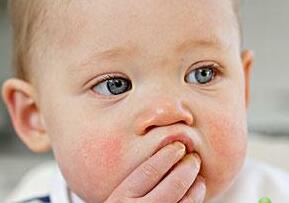 新生兒鵝口瘡有哪些臨床表現？