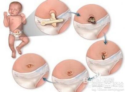 新生兒“臍帶”護理要訣