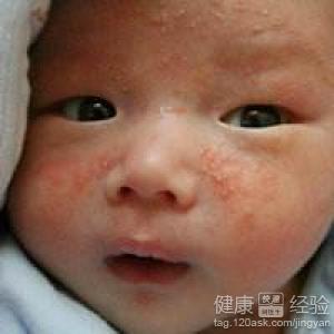 新生兒濕疹是胎毒嗎