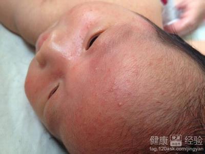 新生兒濕疹治療方法