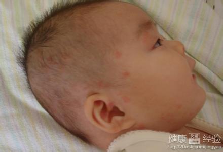 新生兒濕疹怎麼洗臉