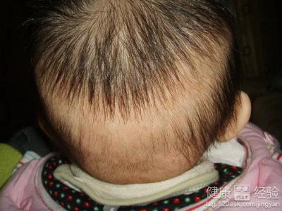 嬰兒枕禿是什麼原因