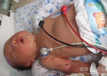新生兒窒息後期需要治療嗎