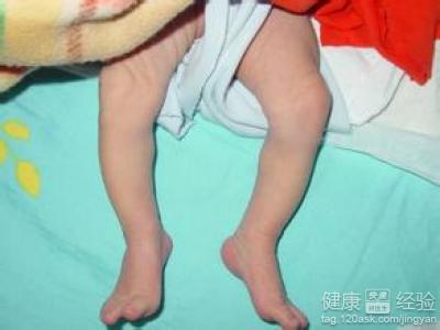 新生兒O形腿矯治好嗎