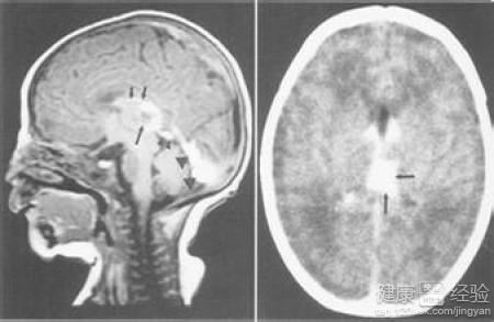 新生兒缺血缺氧性腦病如何治