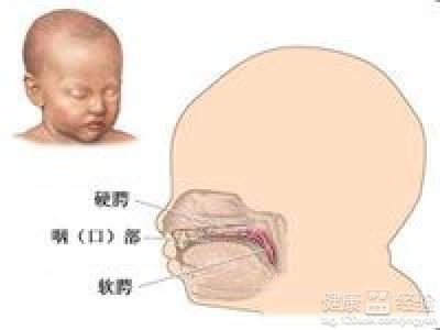是什麼造成新生兒有兔唇缺陷呢