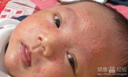 新生兒濕疹的症狀是怎樣的