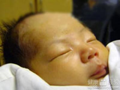 新生兒病理性黃疸的冶療和可能出現的後遺症的防冶