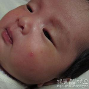 新生兒濕疹應該怎麼處理？