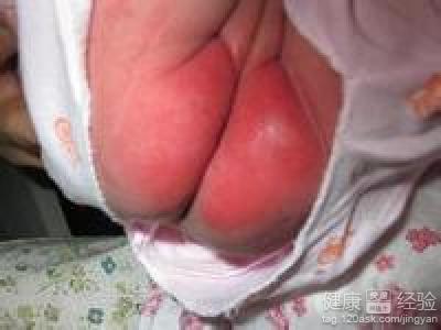 怎麼才能知道新生兒長了尿布疹？