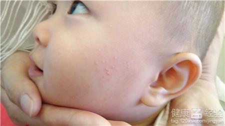 五個月的寶寶臉上有濕疹怎麼辦