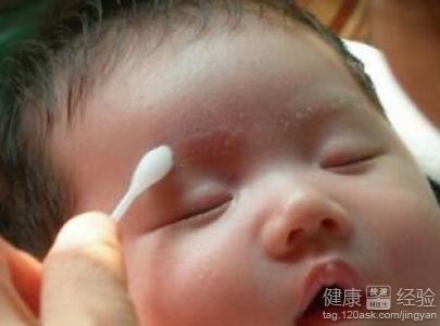 寶寶摩擦性濕疹傳染嗎