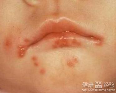 寶寶得了疱疹會傳染嗎