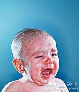 尋麻疹會傳染給寶寶嗎