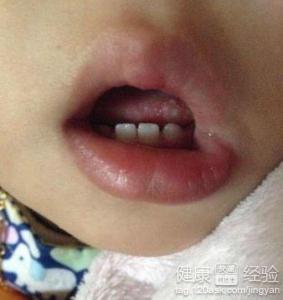 寶寶咽喉疱疹傳染嗎