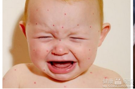 寶寶濕疹吃中藥可以嗎