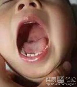 寶寶疱疹性咽炎拉肚子