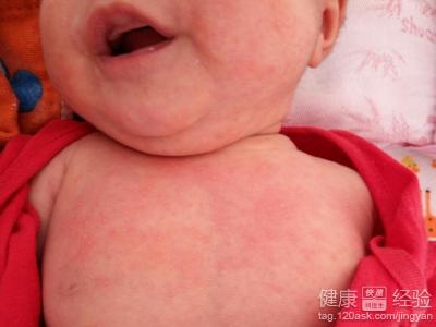 寶寶濕疹藥膏不含激素嗎