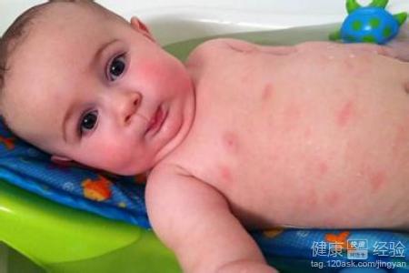 寶寶濕疹應該注意什麼好