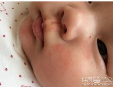 寶寶濕疹怎麼治療能去根