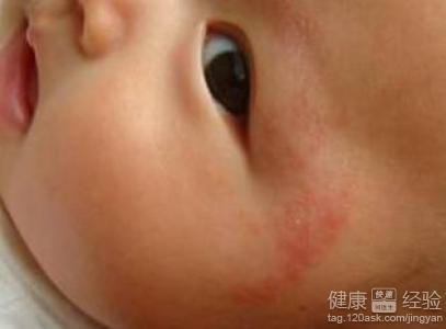 寶寶濕疹需要注意什麼好