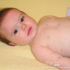 寶寶總是得疱疹怎麼辦