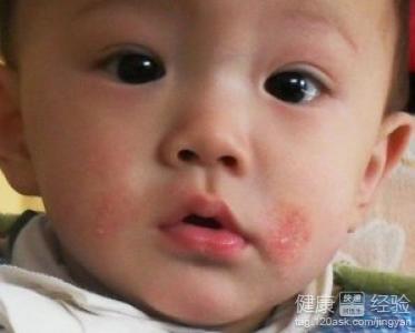 寶寶濕疹能查過敏原嗎