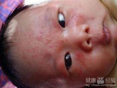 寶寶吃母乳過敏起濕疹