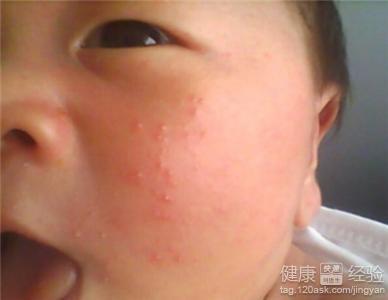 寶寶過敏濕疹怎麼辦