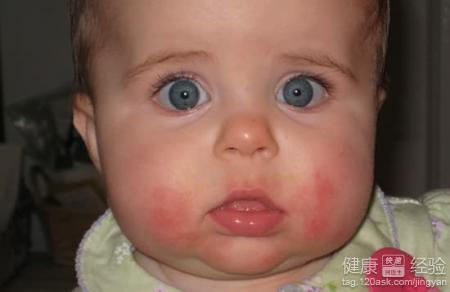 寶寶起濕疹用什麼藥