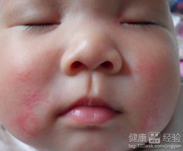 寶寶濕疹用什麼藥膏呢