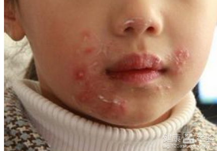 寶寶病毒性疱疹傳染嗎