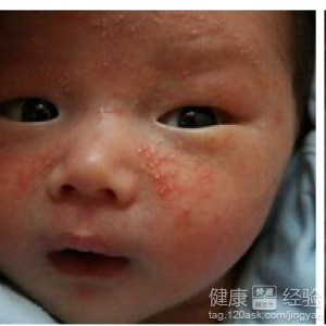 寶寶過敏性濕疹會好嗎