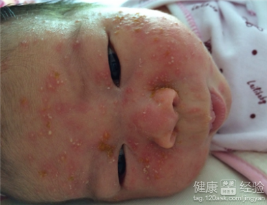 嬰兒痤瘡是什麼原因引起的?
