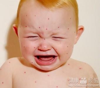 嬰兒濕疹症狀和治療方法