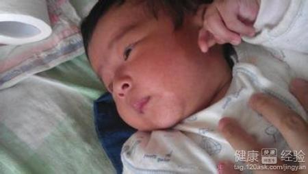 嬰兒白癜風早期症狀
