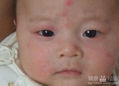 寶寶臉上皮膚過敏是怎麼回事