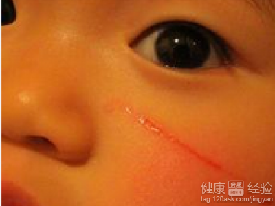 寶寶臉上疤痕怎麼辦