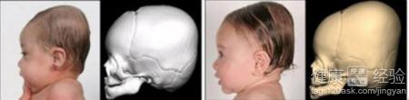 腦部CT對嬰兒會有怎樣的影響