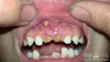 2歲小孩門牙齲齒