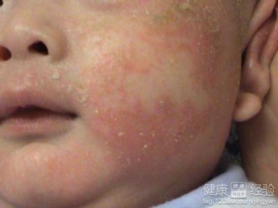 嬰兒濕疹最佳治療方法