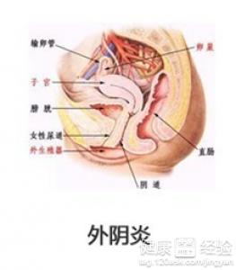 嬰幼兒外陰炎怎麼辦