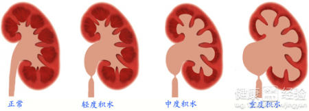 嬰兒腎積水怎麼治療