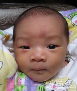 嬰兒臉上長紅斑怎麼辦
