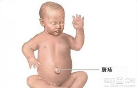 嬰兒肚臍突出怎麼辦
