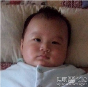 嬰兒一邊臉大一邊臉略小是怎麼辦
