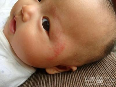 寶寶臉上長濕疹怎麼辦呢