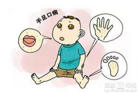 手足口病幾天能好手足口病的症狀