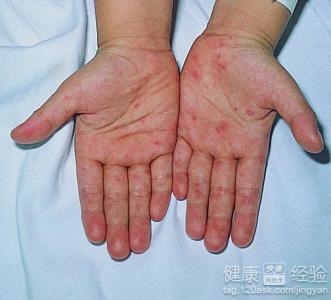 手足口病初期症狀以及預防方法