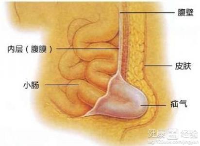 小兒疝氣手術後吃什麼